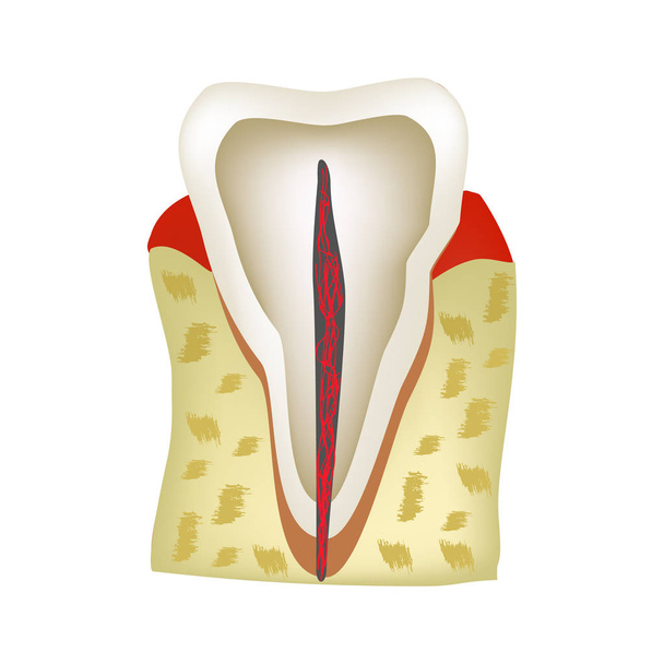 A estrutura anatômica do dente. Infográficos. Ilustração vetorial sobre fundo isolado
 - Vetor, Imagem