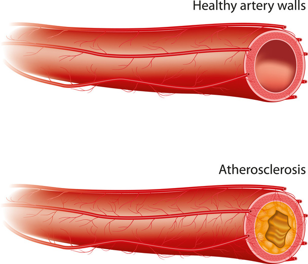 Aterosclerosis - Vector, imagen