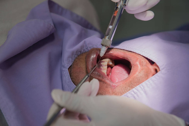 Anesthesia for tooth extraction by the dentist. Dentistry in hospital - Photo, Image