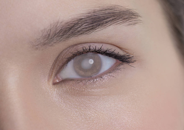 Глаз женщины с катарактой и непрозрачностью роговицы
 - Фото, изображение