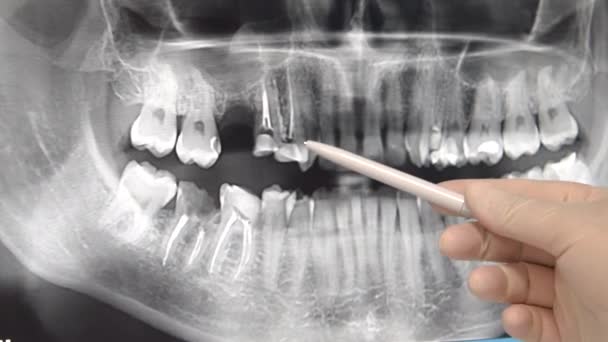 Foto ravvicinata del medico dentale che mostra una maniglia sul roentgen dei denti dell'uomo
. - Filmati, video