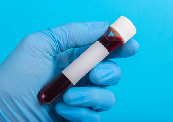 Campione di sangue in vitro alla mano in guanto
 - Foto, immagini