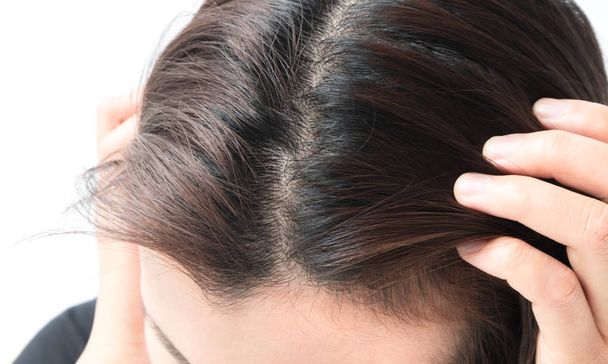 Nő súlyos hajhullás probléma egészségügyi sampon és szépségápolási termék koncepció - Fotó, kép
