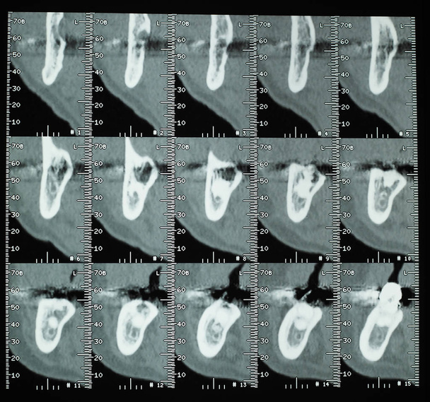 CT scan (aka CAT scan) cross sectional tomographic images x ray of human teeth bones - Photo, Image
