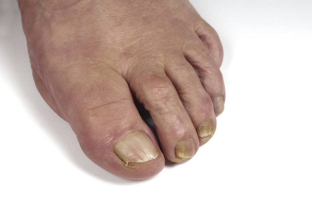 donna anziano piede su bianco
 - Foto, immagini