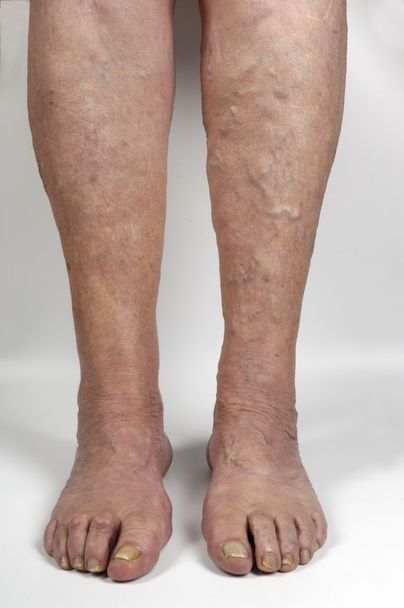 варикозне розширення вен в нозі жінки
, - Фото, зображення