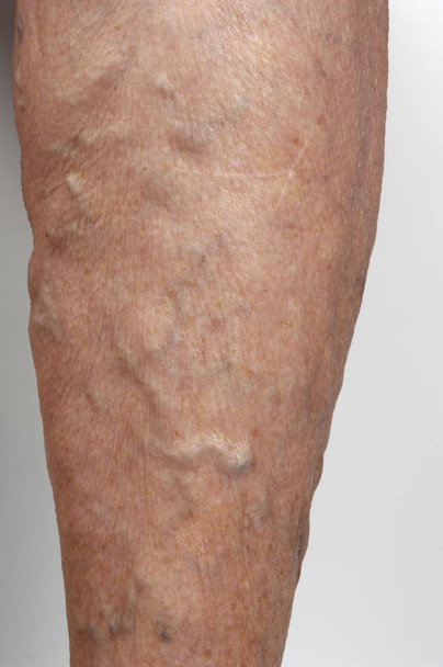 κιρσώδεις φλέβες στο πόδι μιας γυναίκας, - Φωτογραφία, εικόνα