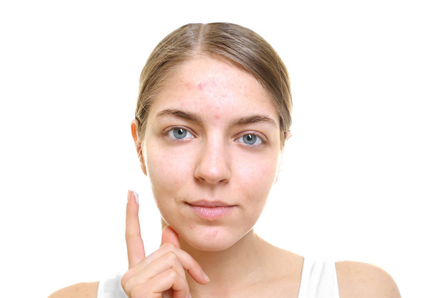 Beautiful young woman applying cream for problem skin onto face, on white background - Valokuva, kuva