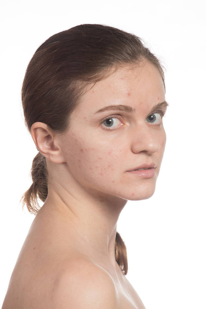 Beautiful young girl with red and white acne on her face. Before - Foto, Bild