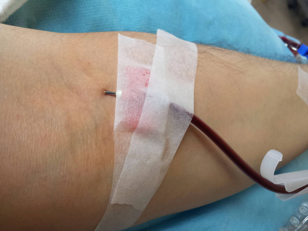 arm of a man at the hospital when donating blood with the needle - Photo, Image
