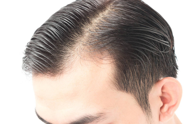 Młody mężczyzna problem utraty włosów poważne dla opieki zdrowotnej szampon i piękna koncepcji produktu - Zdjęcie, obraz