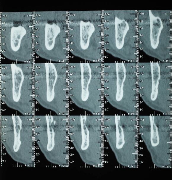 CT vizsgálat (aka CT) kereszt szekcionált tomográfiás képek x ray, az emberi fogak csontok - Fotó, kép