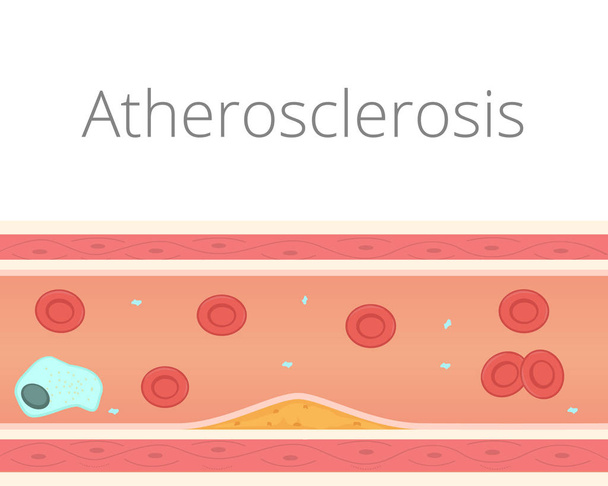 Illustrazione vettoriale di aterosclerosi. Placca aterosclerotica nel lume del vaso
 - Vettoriali, immagini