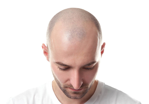 Hair loss concept. Head of man on white background, closeup - Photo, image