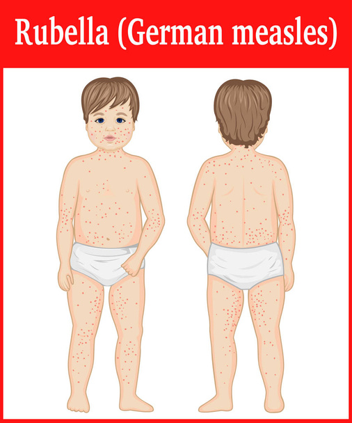 Uma criança infectada com rubéola
 - Vetor, Imagem