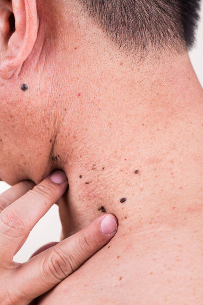 Finger embrace mole on neck and shoulder of Asian male - Photo, Image