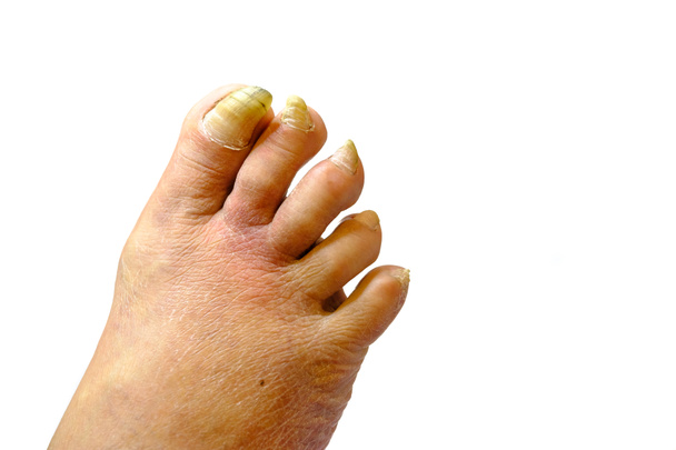 Sairas epäterveelliset kynnet jalka mies
 - Valokuva, kuva