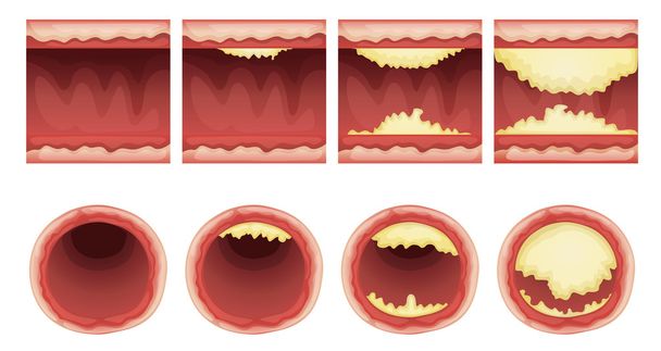 歯垢の蓄積 - ベクター画像