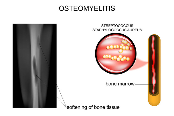 lesões ósseas osteomielite
 - Vetor, Imagem