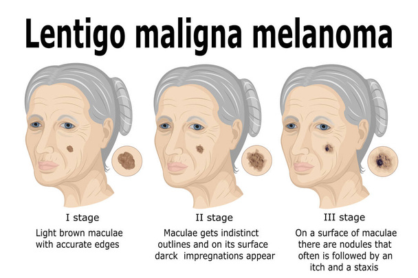 Lentigo maligna melanoma - Vector, afbeelding