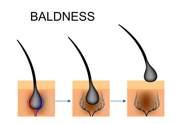 schending van de bloedcirculatie in de haarfollikel. kaalheid - Vector, afbeelding