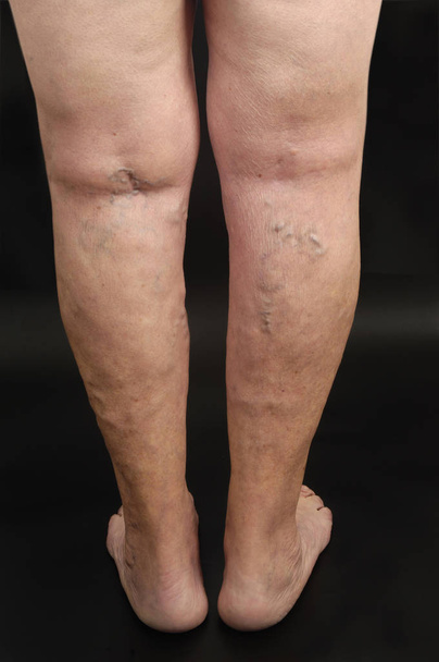 varicose veins in the leg of a woman,  - Photo, Image