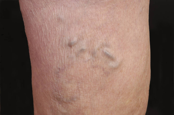 κιρσώδεις φλέβες στο πόδι μιας γυναίκας,  - Φωτογραφία, εικόνα