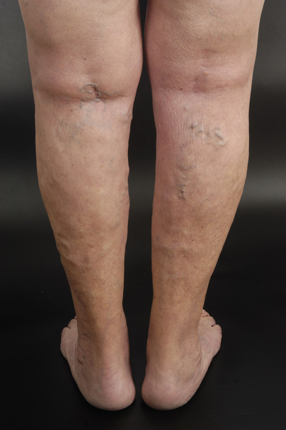 venas varicosas en la pierna de una mujer
,  - Foto, imagen