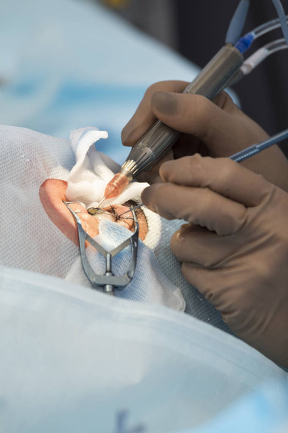 Lente cristalina método quirúrgico reemplazable
 - Foto, imagen