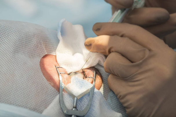 Kiteinen linssi vaihdettava kirurginen menetelmä
 - Valokuva, kuva