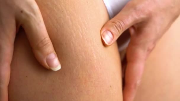 Vrouwelijke hip striae op de huid - Video