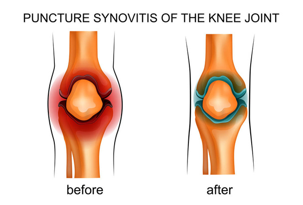 παρακέντηση υμενίτιδα του γόνατος - Διάνυσμα, εικόνα