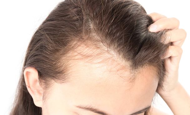Mujer grave problema de pérdida de cabello para el cuidado de la salud champú y concepto de producto de belleza
 - Foto, Imagen