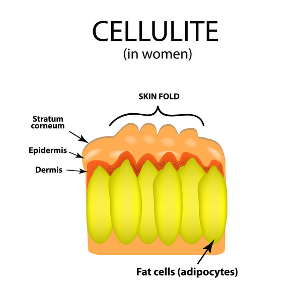 Hautalterung bei Frauen. Zellulitis. Infografiken. Vektor-Illustration auf isoliertem Hintergrund - Vektor, Bild