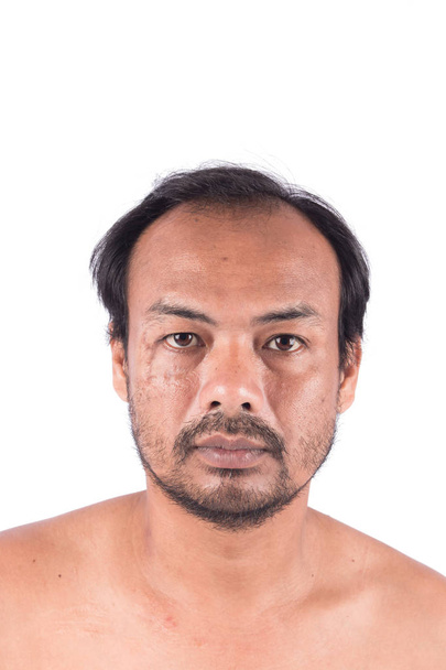 Cicatrices de point sur le visage et la tête chauve du jeune homme
  - Photo, image