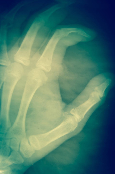 Radiografia della mano su sfondo scuro concetto medico
. - Foto, immagini