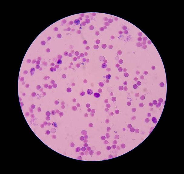 Reticulocitos con glóbulos rojos en frotis de sangre
. - Foto, Imagen