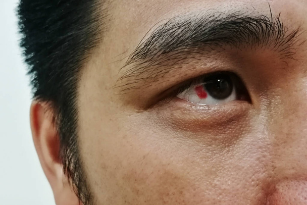 Coup de sang rouge oeil droit
  - Photo, image