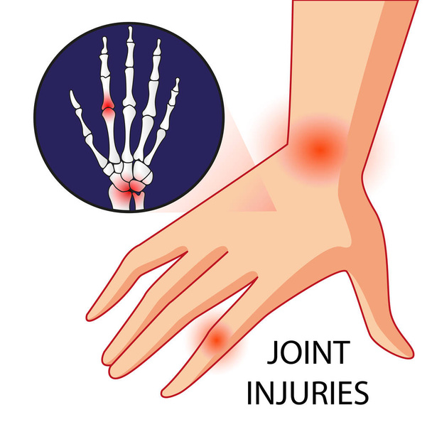 Ilustracja wektora ból kości i stawów kolana - Wektor, obraz