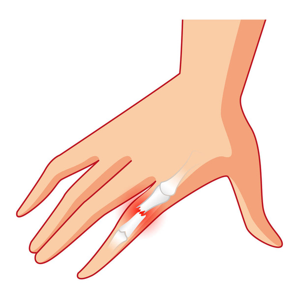 Кость руки и пальца, боль, рентген, сломанная рука
 - Вектор,изображение