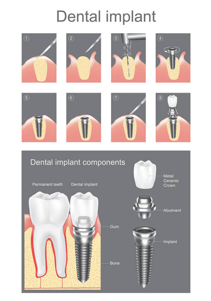Dental implant. Vector graphic design. - Vector, Image