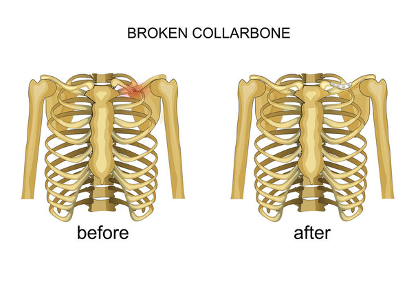 fractura de clavícula. recuperación
 - Vector, Imagen