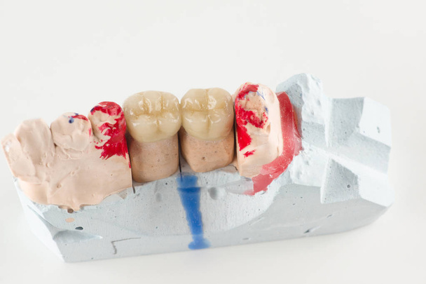 ceramic crowns to try on a tooth model - Foto, imagen