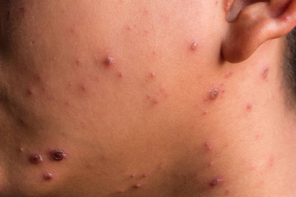 rash da varicella
 - Foto, immagini