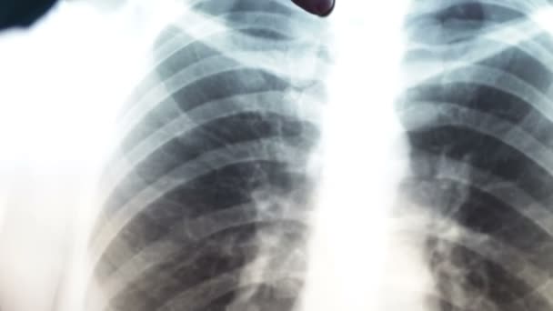 Röntgenbild menschlicher Lungen: Diagnostik zur Vorbeugung von Lungenkrebs. - Filmmaterial, Video