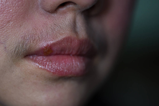 Primo piano dell'infezione da virus dell'herpes sulla bocca della donna
. - Foto, immagini