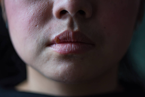 Close up of herpes virus infection on woman mouth. - Photo, Image