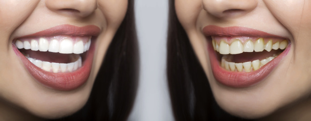 Wybielanie zębów, stomatologia, usługi stomatologiczne na porównanie przed i po. Białe zęby i żółte zęby z płytki nazębnej w ustach kobiet z uśmiechem. Radość po dentysta. Sukces zdrowie procedury - Zdjęcie, obraz