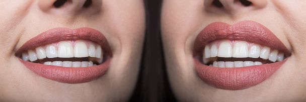Injeções de enchimento labial antes e depois. Enchimentos labiais e injeções de botox. Aumento dos lábios. Lábios Perfeitos Bonitos. Boca sexy de perto. Lábios gordos sexy após injeção de enchimento e injeção de seringa
 - Foto, Imagem