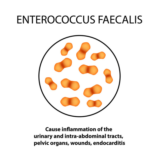 Enterococcus faecalis. Flora patogena. Il batterio provoca malattie intestinali. Infografica. Illustrazione vettoriale
. - Vettoriali, immagini